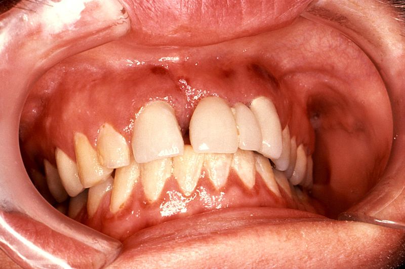 Tooth Infections