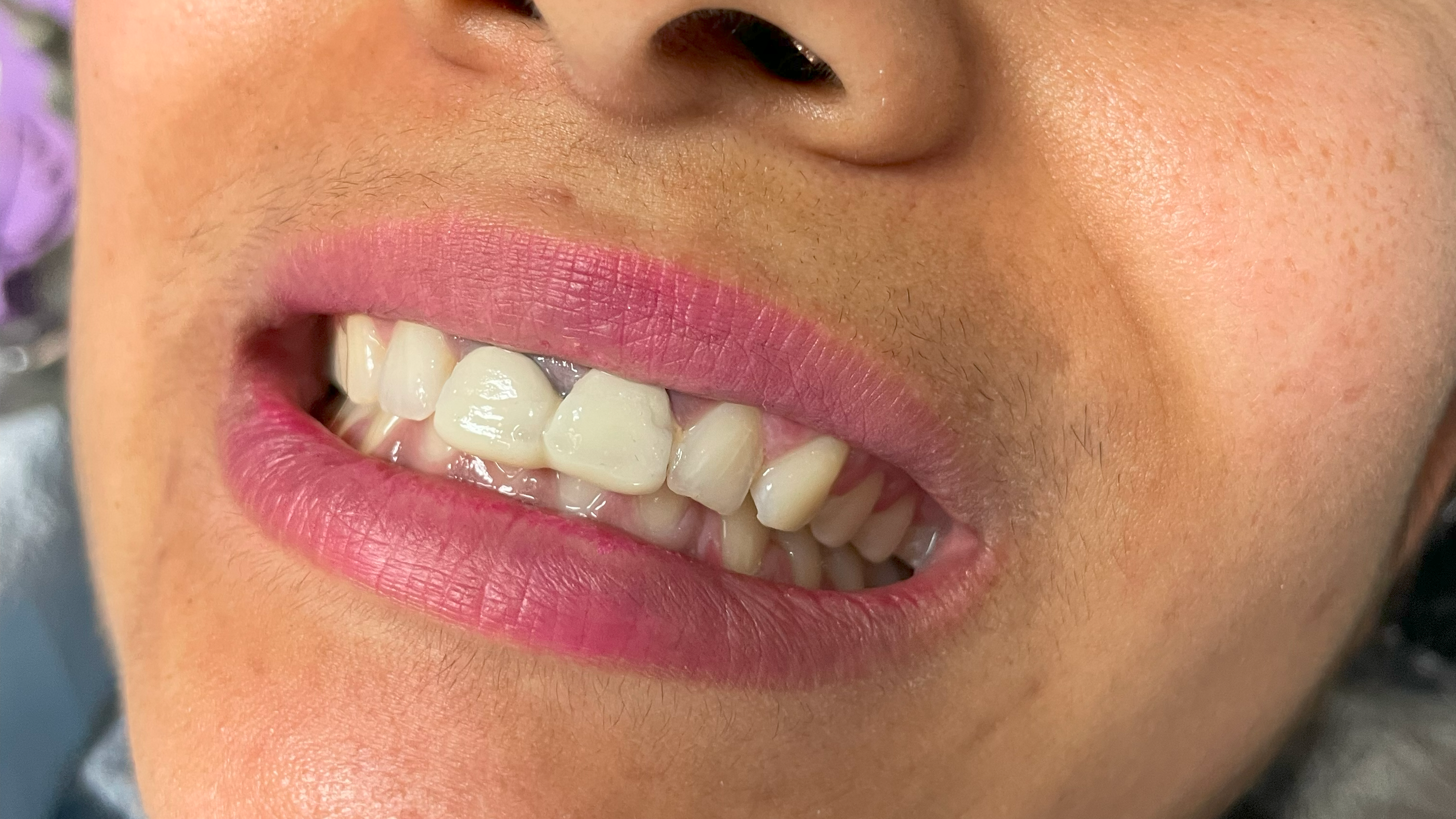 dental front crown before image